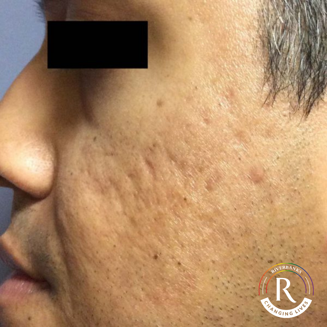 Cool Laser Acne Scars