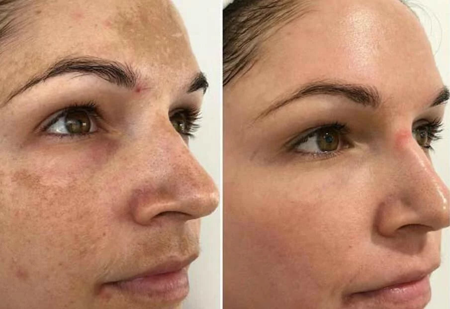 Cosmelan De-Pigmentation peel