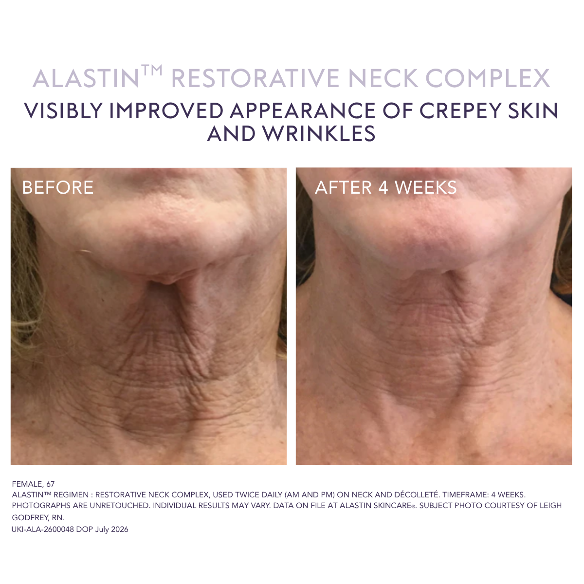 Alastin Restorative Neck Complex